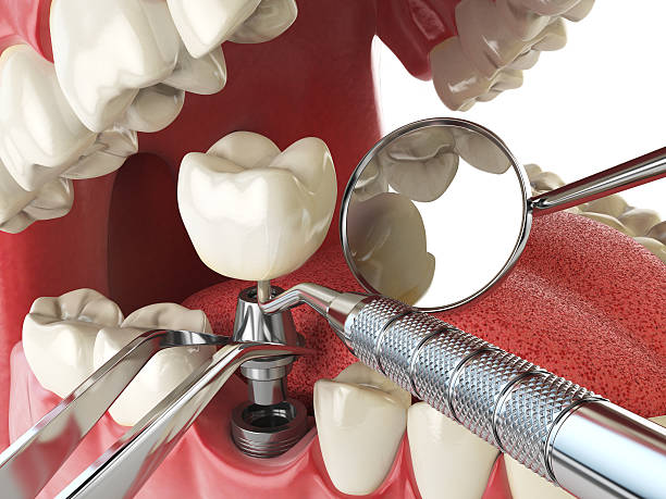 Best Lost Filling or Crown Replacement in Quail Ridge, FL